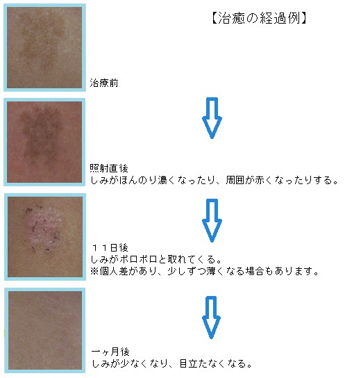 光治療の治癒経過例